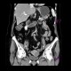 Fibroid of uterus: CT - Computed tomography